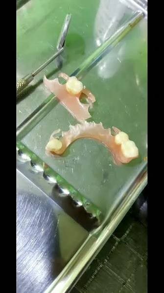 ফ্লেক্সিবল ডেনচার লাগানো