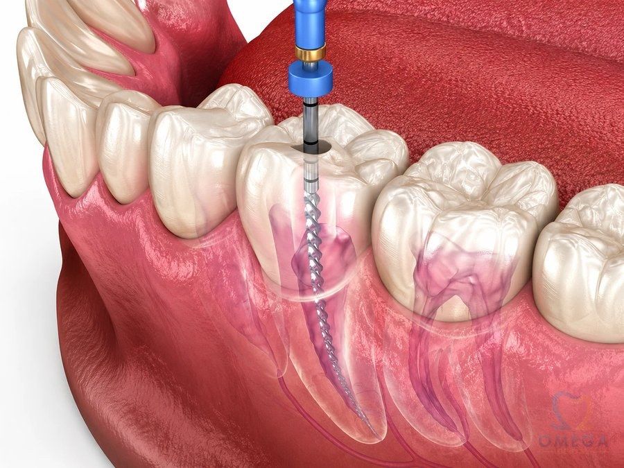 Root Canal (RCT)