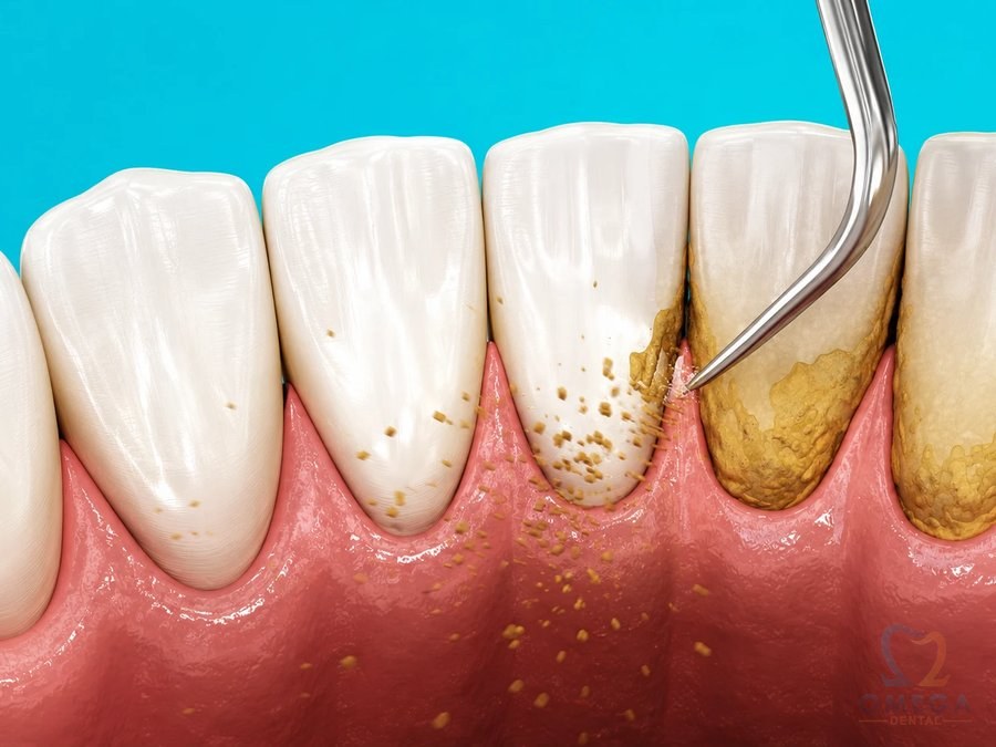 Scaling & Polishing