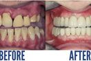 Zirconia Crown - Before & After