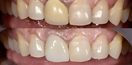 PFM Crown - Before & After