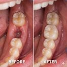 Fiber Bridge - Before & After