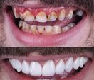 Tooth Filling - Before & After