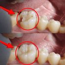 Decayed Tooth Filling - Before & After