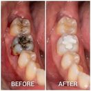 Cavity Filling - Before & After