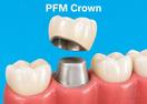 PFM Crown
