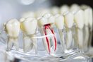 Root Canal Treatment