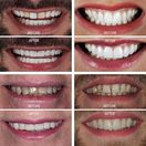 Composite Veneer - Before & After