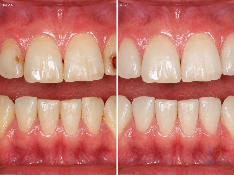 Tooth Fillings